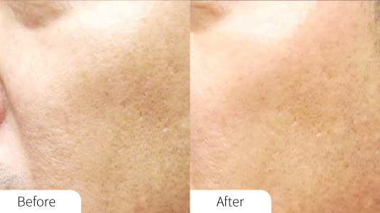 Aquapure Before and After