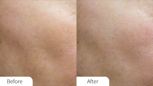 Aquapure Before and After