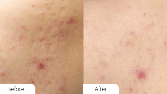 Aquapure Before and After