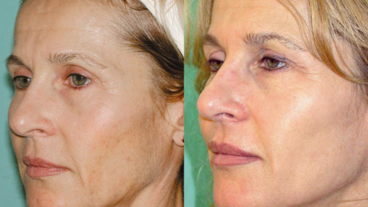 Dermaceutic  Cosmo Peel Before and After