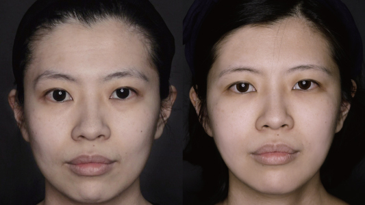 AestheFill 精靈針 Before and After 效果