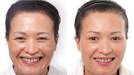 Botox 肉毒桿菌素 Before and After