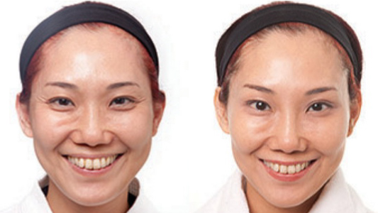 Botox 肉毒桿菌素 Before and After