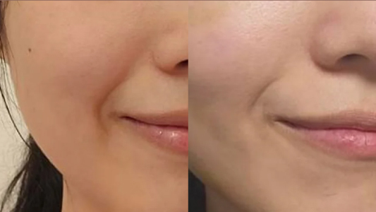 Skinvive 昇光針 Before and After