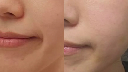 Skinvive 昇光針 Before and After