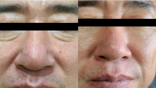 Ultra V Lift 埋線 Before and After