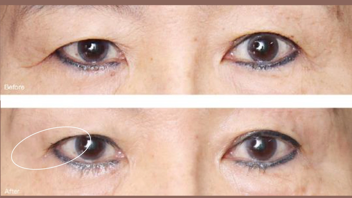Density 無雙電波 Before and After