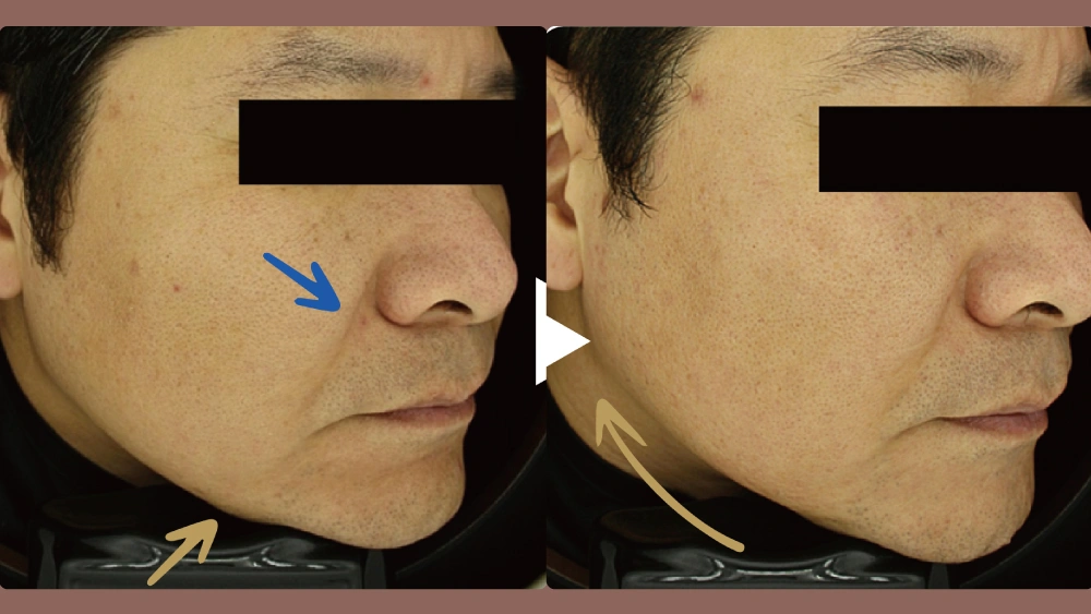 Duo Tite 矽谷音波 Before and After