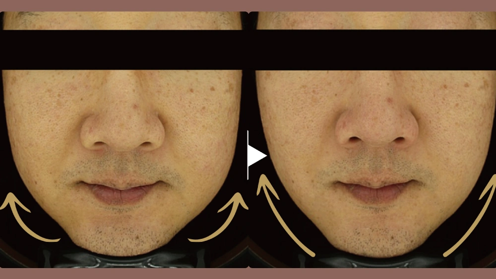 Duo Tite 矽谷音波 Before and After