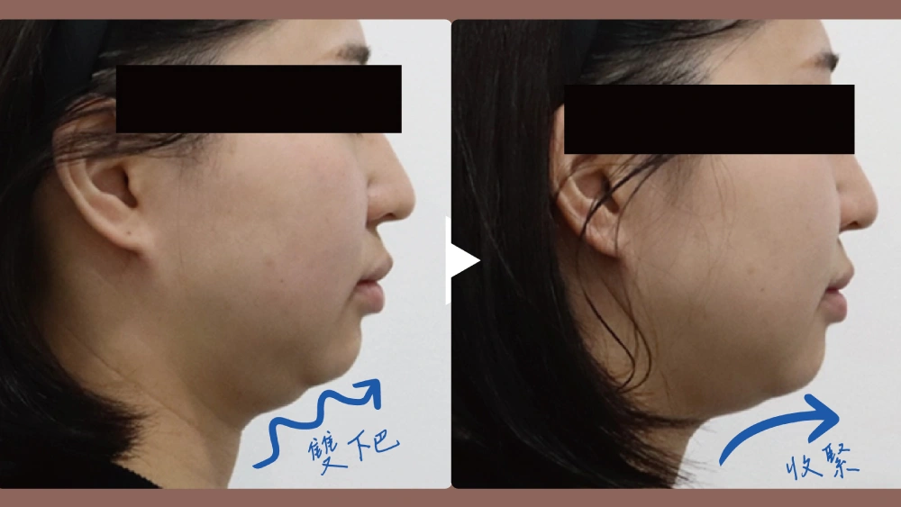 Duo Tite 矽谷音波 Before and After