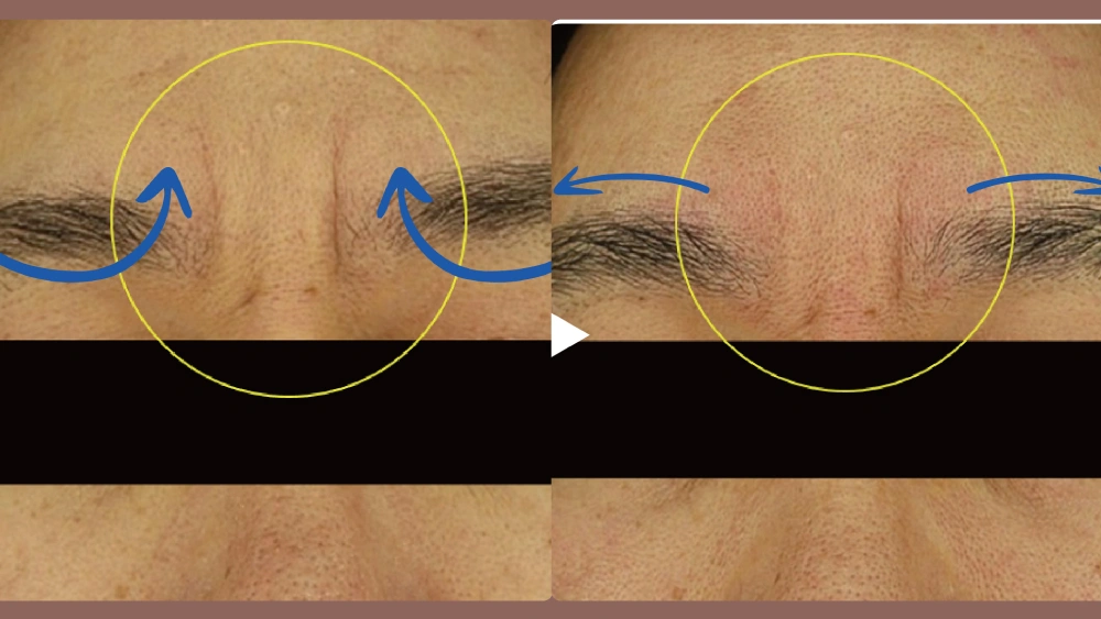 Duo Tite 矽谷音波 Before and After