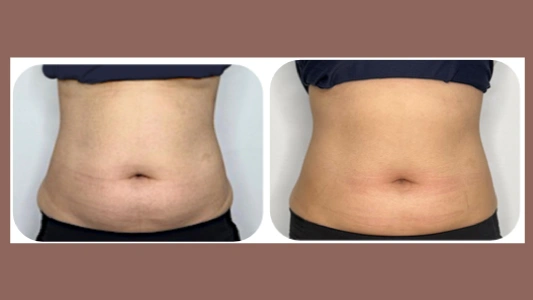 Indiba Deep res6 和 Indiba IA pro max