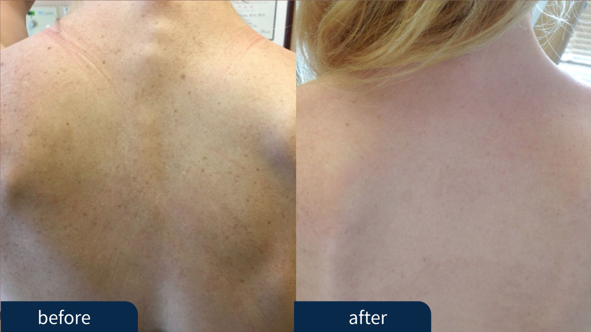 Lumenis PiQo4 Before and After