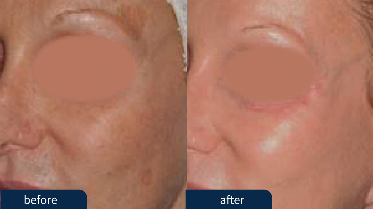 Lumenis PiQo4 Before and After