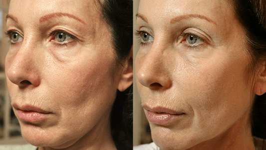 Thermage Flx Before and After