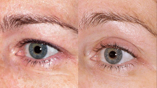 Thermage Flx Before and After