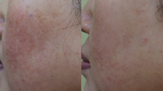 Ultracel Q+ hifu Before and After