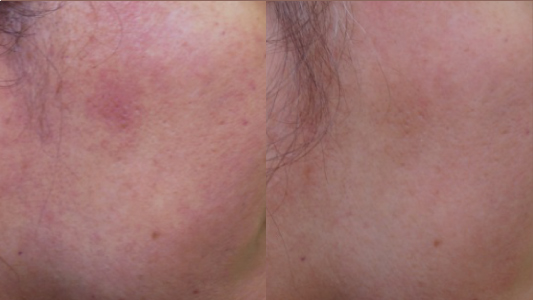 Ultracel Q+ hifu  Before and After