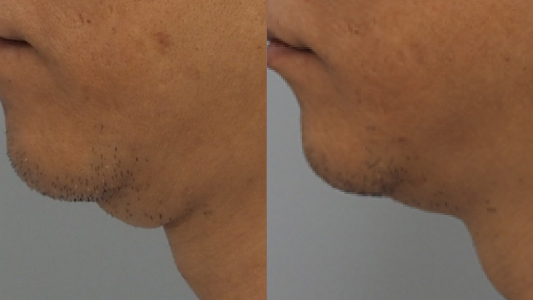 Ultracel Q+ hifu Before and After